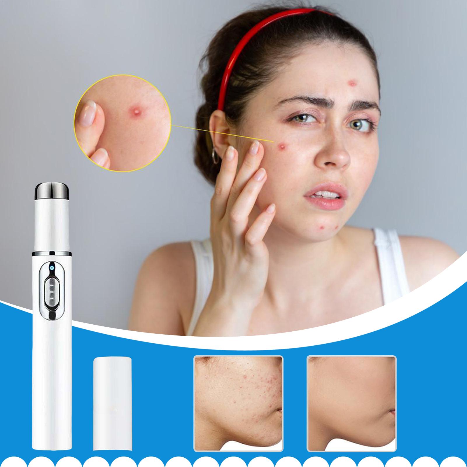 Mole Remover Pen Portable Skin - огляд і ціна Women Accessories Combo
